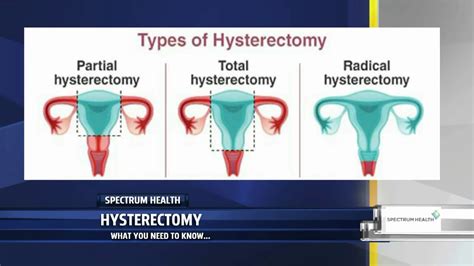 is hysterectomy considered as pwd